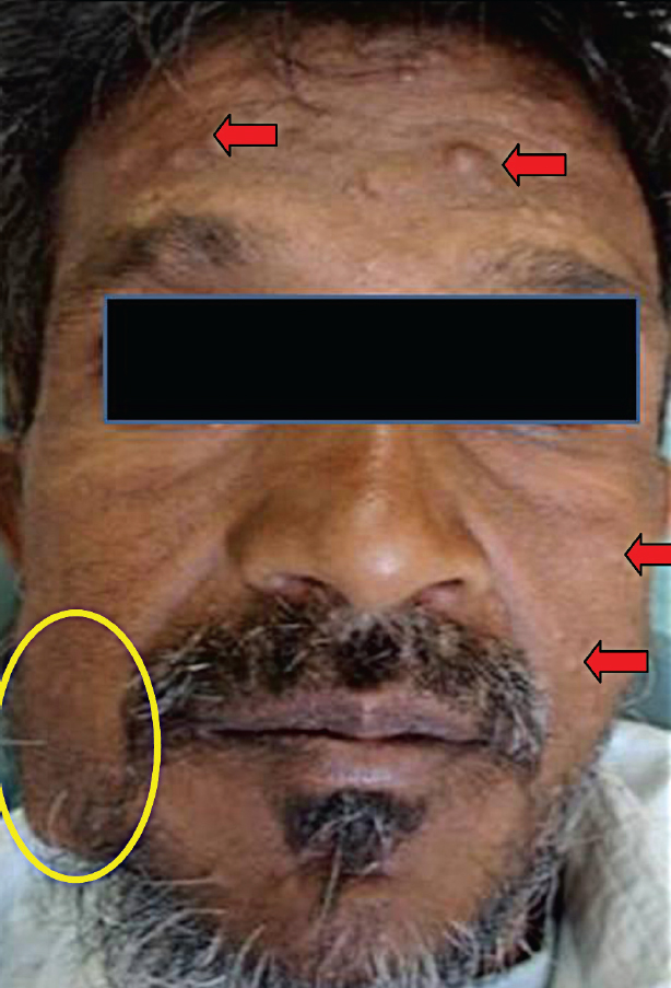 Myoepithelial cell carcinoma of the oral cavity