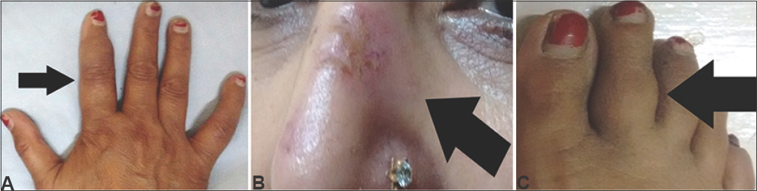 Osseous sarcoidosis with lupus pernio