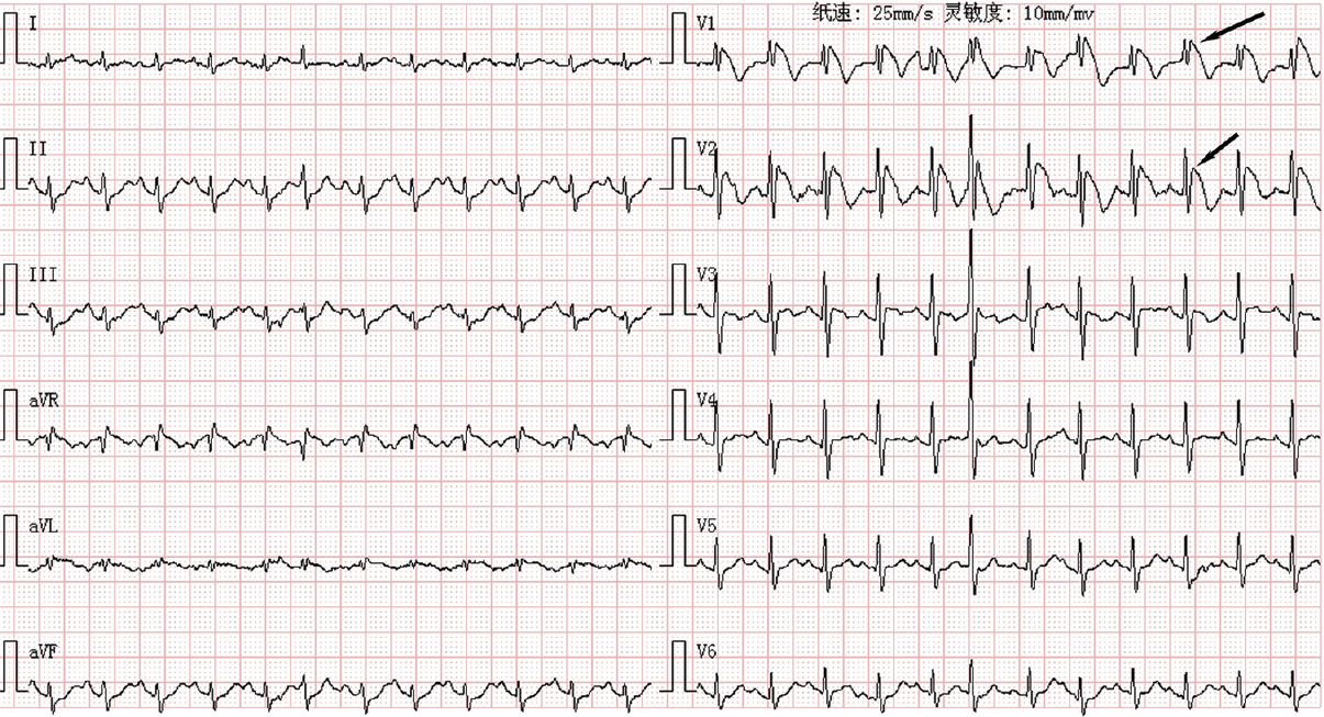 An older male with fever-induced Brugada Syndrome