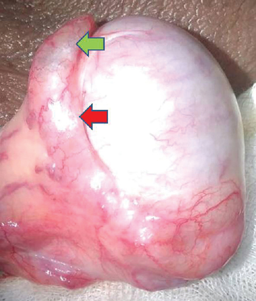 Prospective analysis of factors predicting feasibility & success of longitudinal intussusception vasoepididymostomy in men with idiopathic obstructive azoospermia