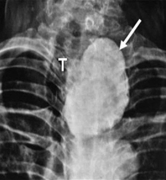 An egg in the neck: A rare case of massively calcified thyroid nodule