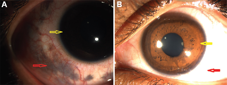 Oculodermal melanocytosis