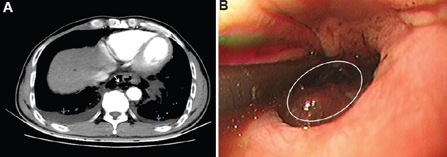 Boerhaave’s syndrome: A case of spontaneous oesophageal rupture