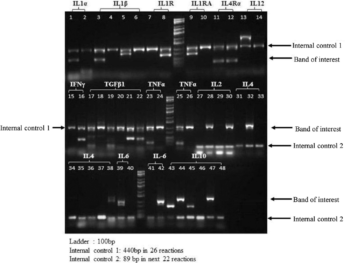Polymorphism of interleukin-6 -174 G/C (rs1800795) & the corresponding interleukin-6 level as a prognostic marker of cervical cancer