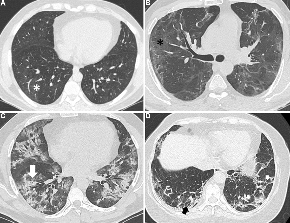 Risk factors for clinically significant diffuse parenchymal lung abnormalities persisting after severe COVID-19 pneumonia