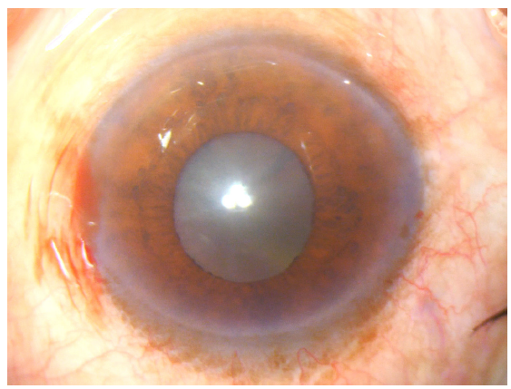 Real-world uptake of an innovative pupil expander device for cataract surgery: Implementation lessons learnt