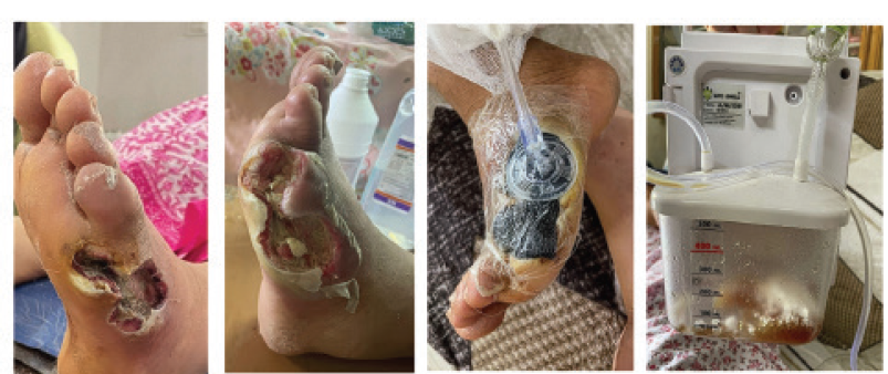 Role of Negative Pressure Wound Therapy in Diabetic Foot Ulcers: A Case Report