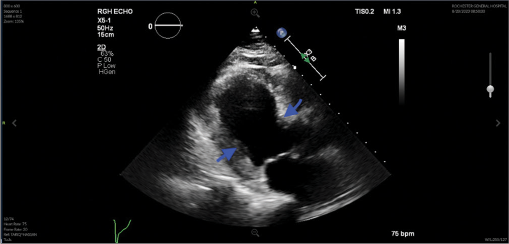 A Case of Takotsubo Cardiomyopathy with Parkinson’s and Possible Heroin Abuse