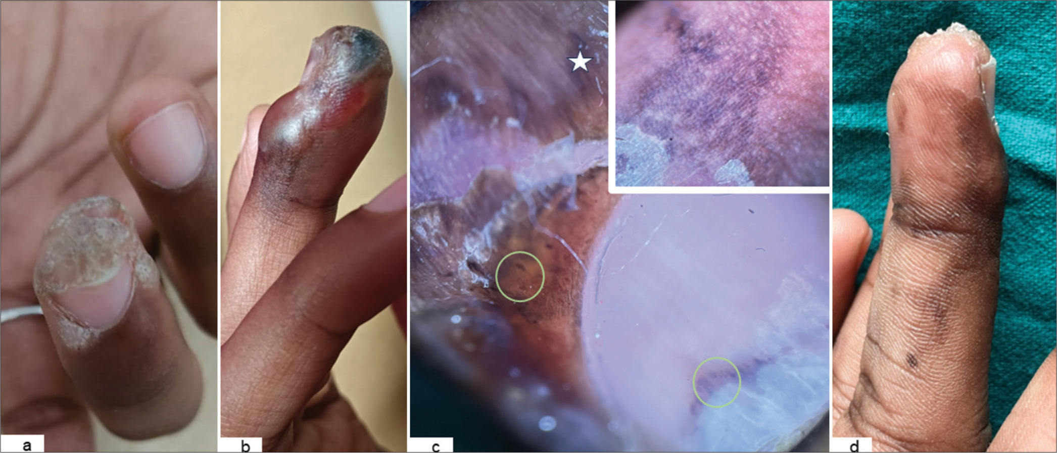 Adverse reaction to intralesional bleomycin therapy for periungual warts: A case report