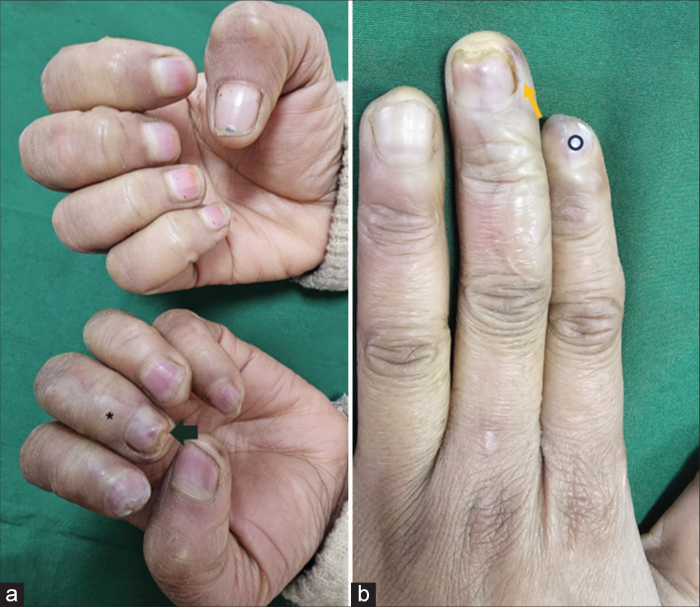 Nail in chilblains – Clinical and onychoscopic findings with review of literature