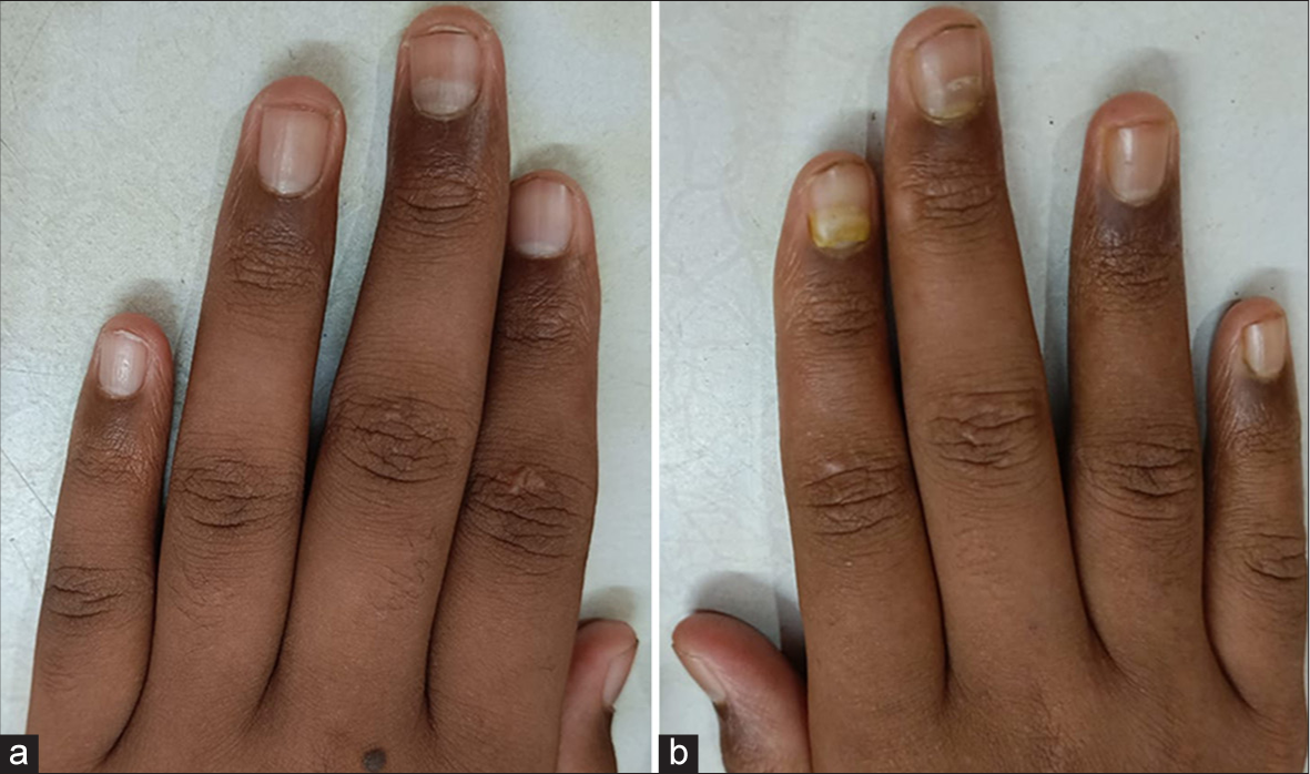 Onychomadesis following hand foot and mouth disease