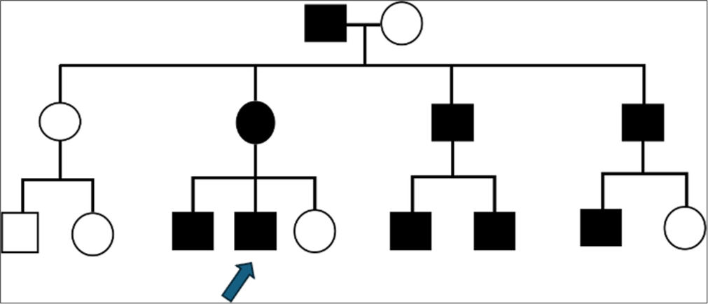 A rare case of familial malalignment of the great toenails