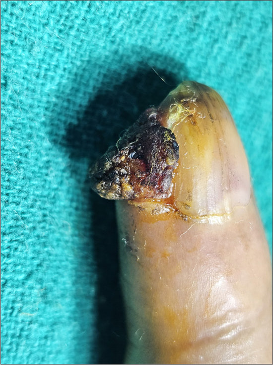 Squamous cell carcinoma of nail unit masquerading as pyogenic granuloma