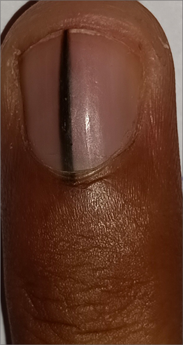 Benign longitudinal melanonychia in skin of color: A case series