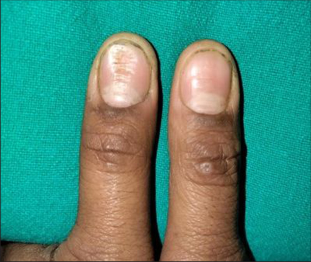 ‘Washboard nails’ secondary to habit-tic deformity versus median canaliform dystrophy of Heller: The morpho-diagnostic conundrum