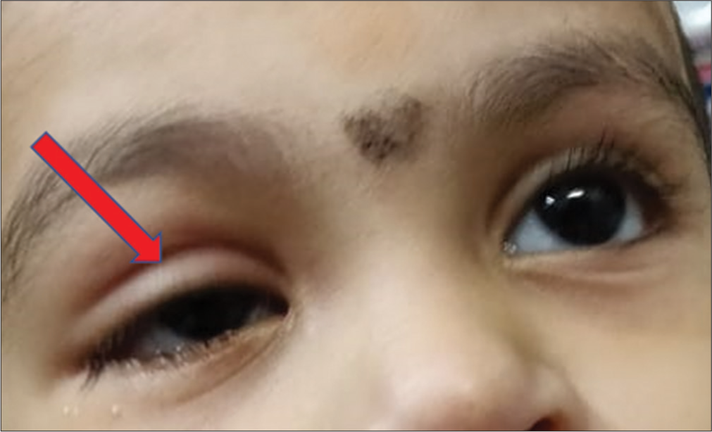 Ocular manifestations of acute myeloid leukemia during induction phase of chemotherapy: A case series