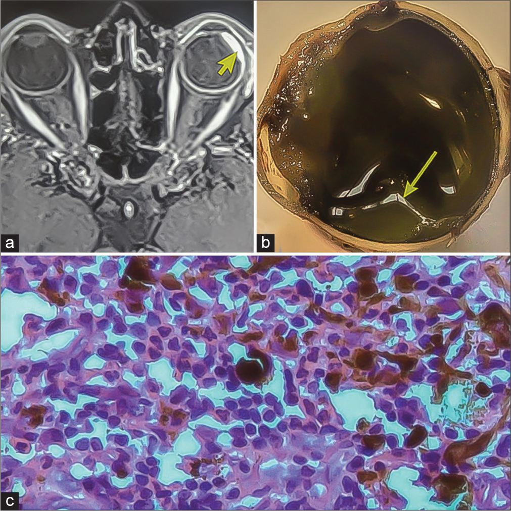 Through the looking glass: Ciliary body leiomyoma with chronic inflammation: A rare case report