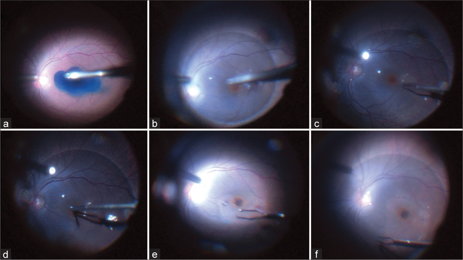 Modified packing technique in large traumatic macular holes