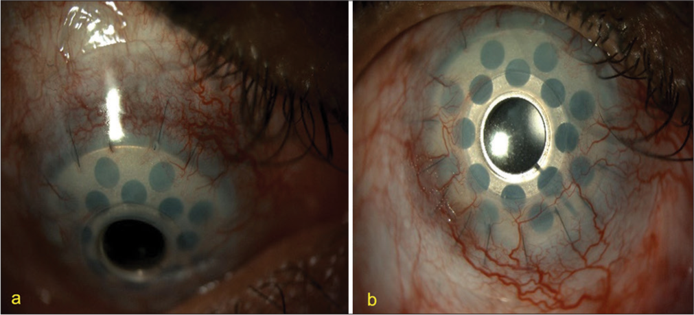 Dual role of bandage contact lens – A case report