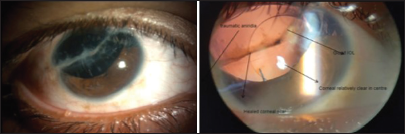 Role of optic zone diameter in scleral lens fitting in traumatic aniridia with scarred cornea – A case report