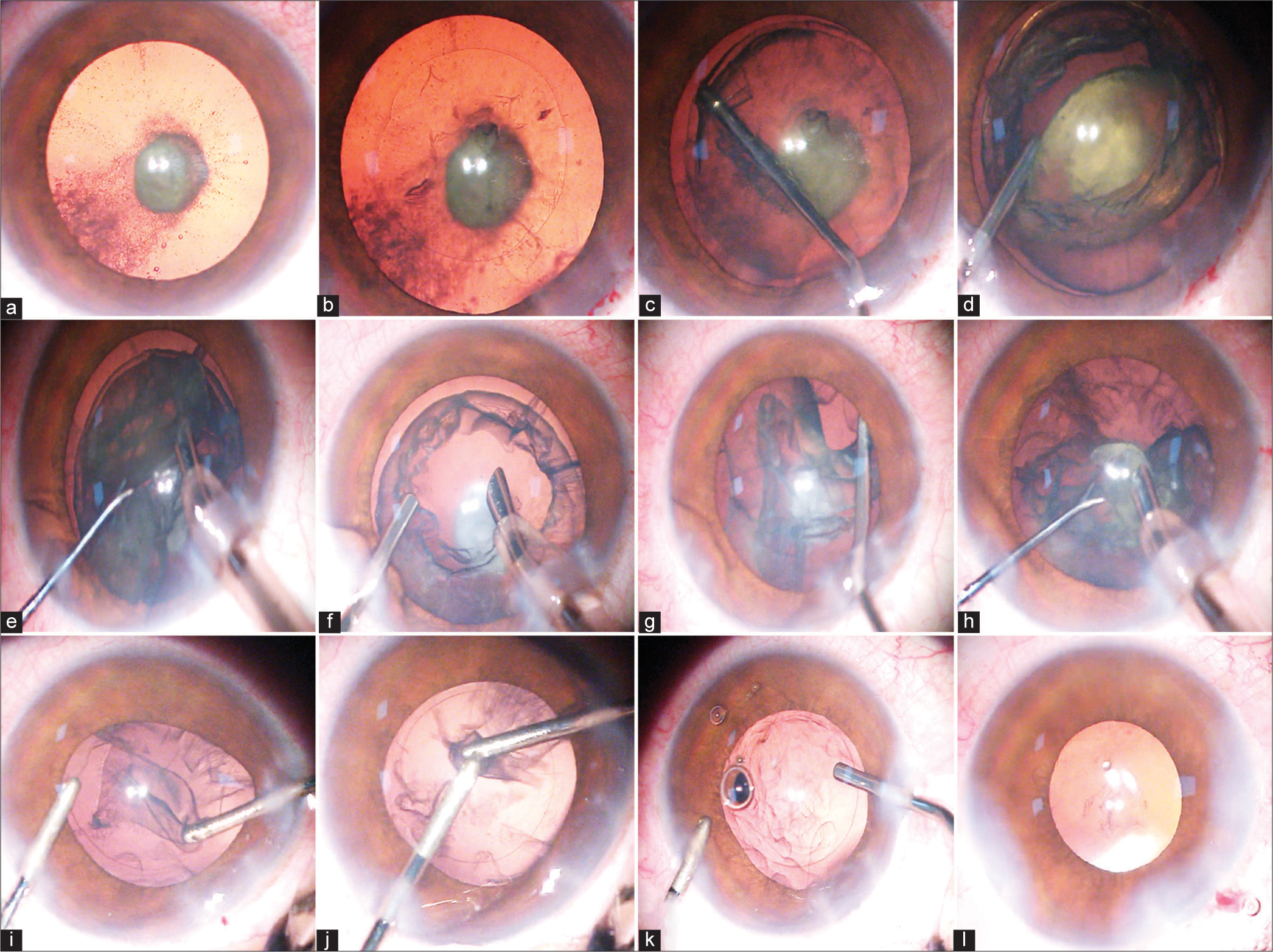 Phacoemulsification in posterior polar cataracts with a soft nucleus: Simple as ABC with proper techniques and precautions