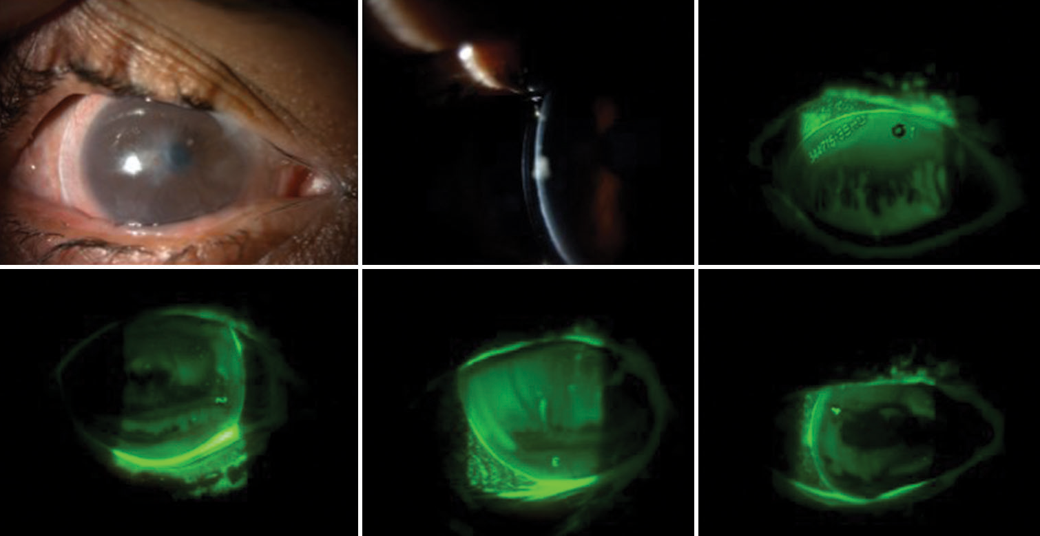 Dual benefits of scleral lenses in collateral cases of Stevens-Johnson syndrome and Keratoconus-A case series