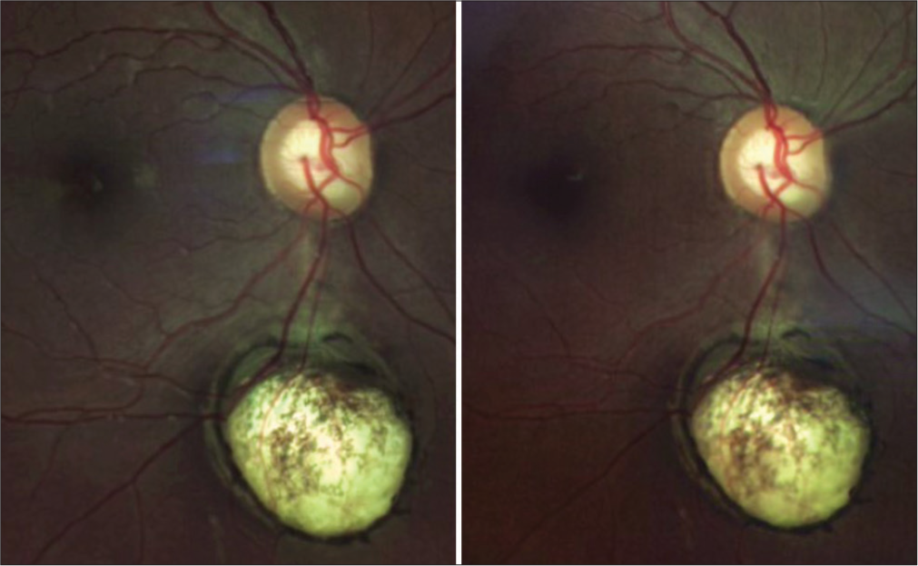 Stereoscopic fundus photograph, optical coherence tomography features, and fundus autofluorescence in a focal combined retinal and choroidal coloboma