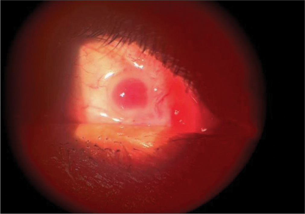 Ocular filariasis in the form of a conjunctival granuloma – A rare case report from non-endemic part of India