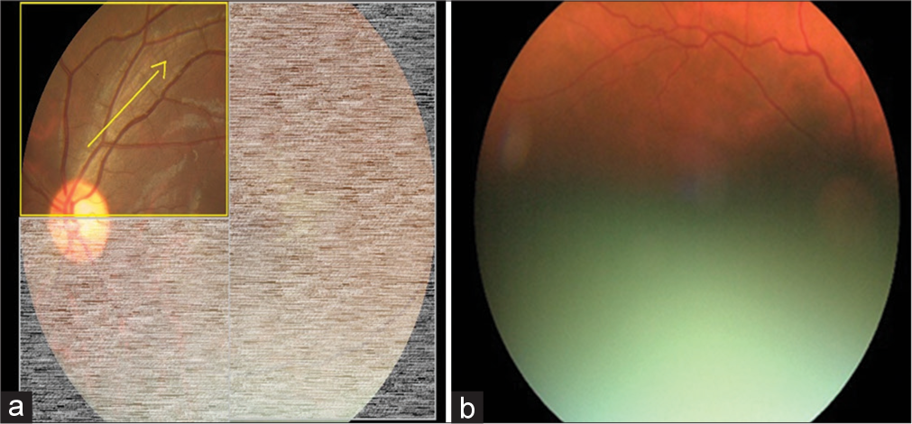 Retinal image quality assessment in diabetic-retinopathy screening: Real world evidence from a lower-middle income country
