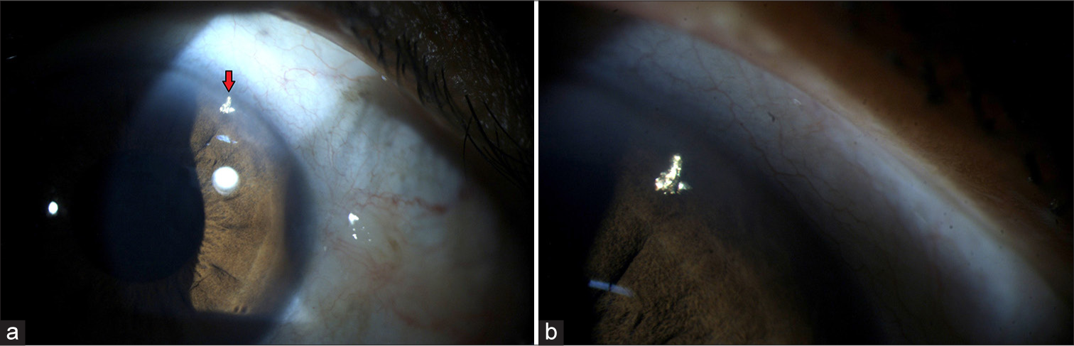 Post phacoemulsification shine: Iatrogenic foreign body deposition