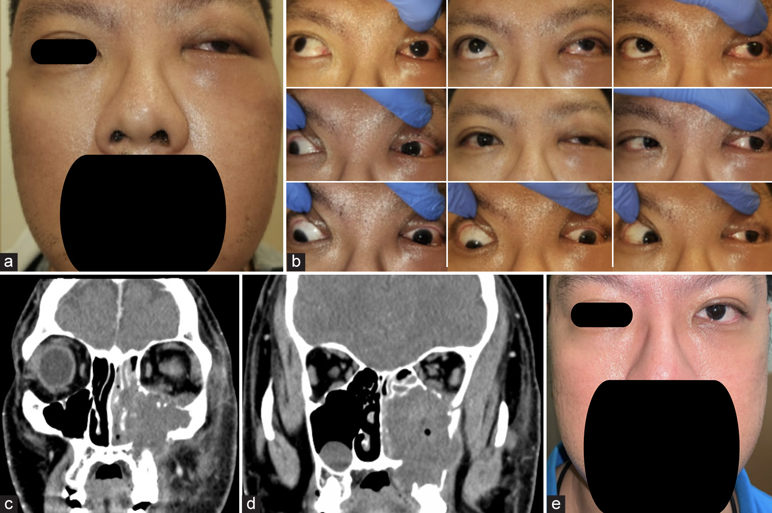 Hot orbits of dental origin – Case series with review of literature