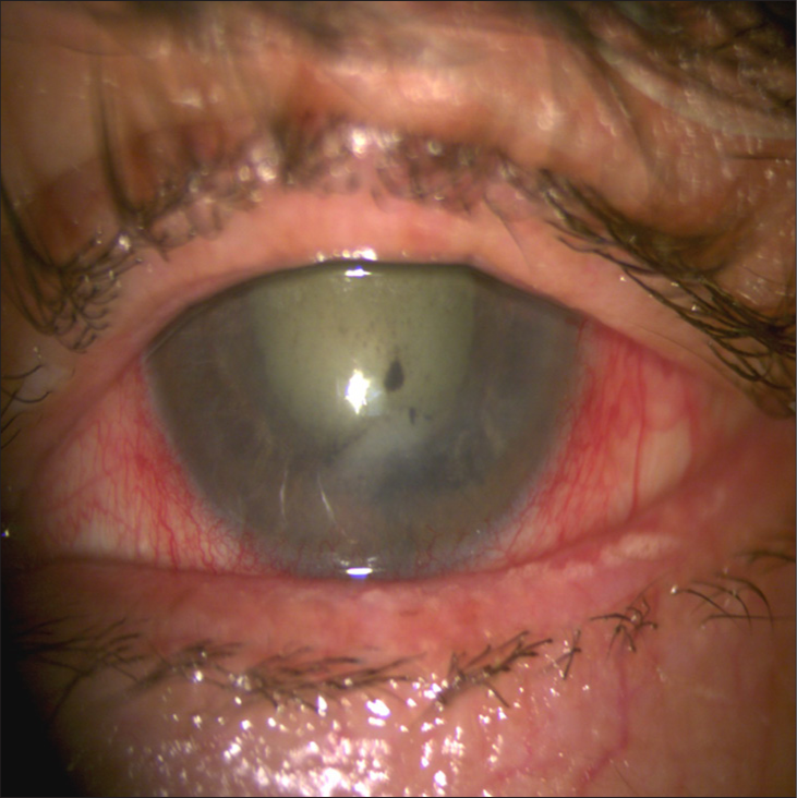 Masquerade syndrome secondary to choroidal melanoma in a 73-year-old patient