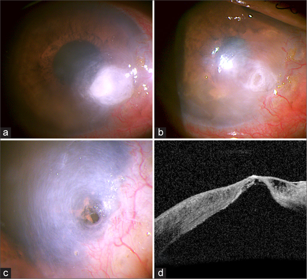 Application of cyanoacrylate glue in corneal impending perforation (descemetocele) under slit lamp biomicroscope