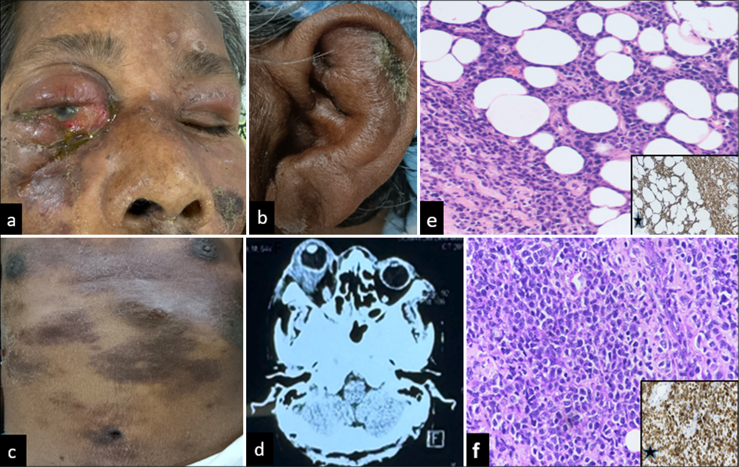 Atypical orbital cellulitis in a leprosy patient –A diagnostic and therapeutic challenge