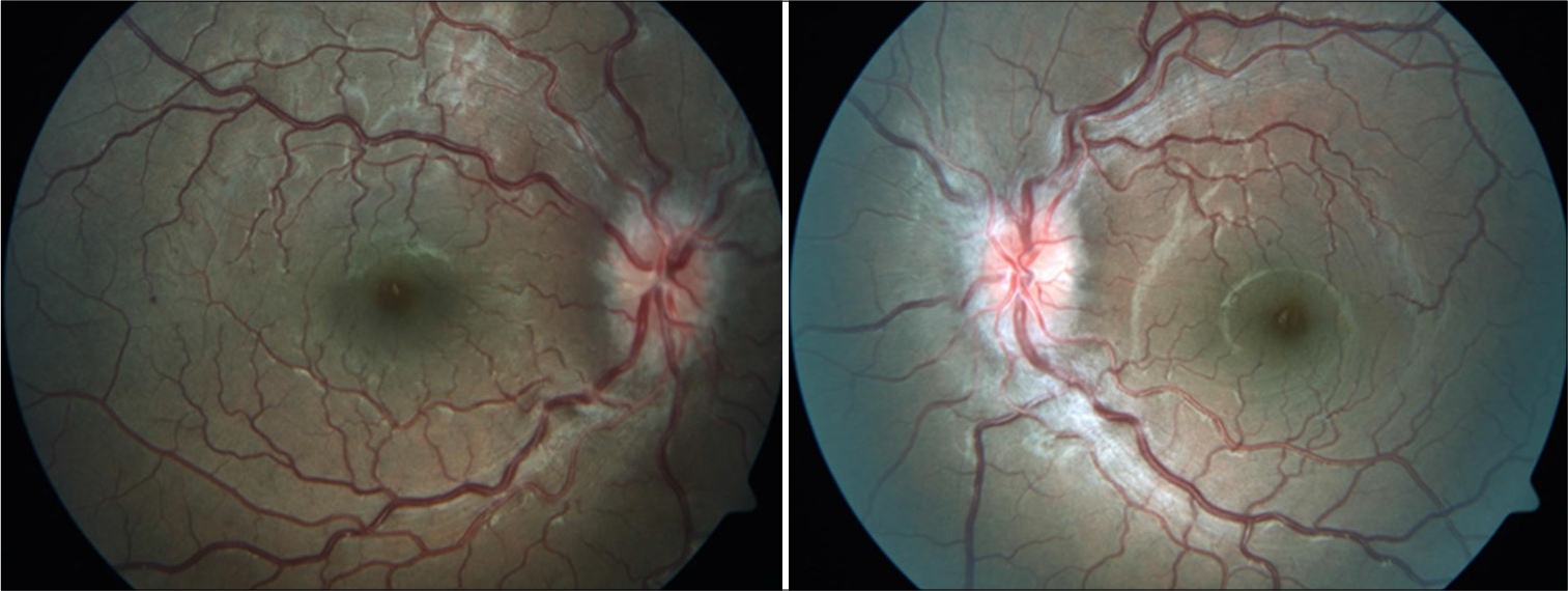 Unusual ophthalmic manifestation in a suspected case of dengue fever