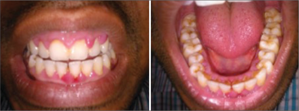 Assessment of effects of duration and dosage of Amlodipine on gingival health - A Prospective Study