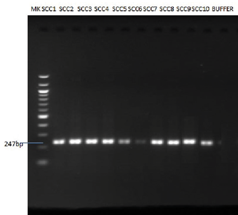 Molecular determination of mutational signatures p53 and RB in human papilloma virus-associated squamous cell carcinoma of the cervix