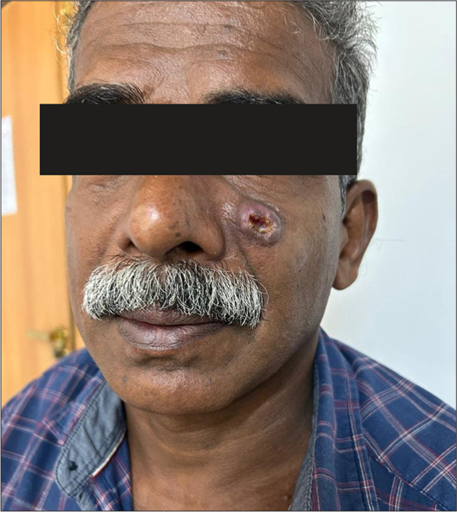 Case report – Muir–Torre syndrome – A skin-deep manifestation of underlying malignancy