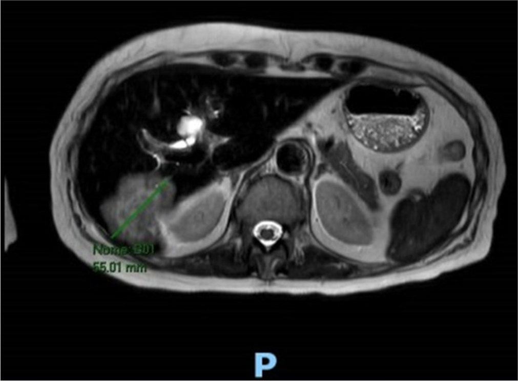 Breast carcinoma disguised as systemic sclerosis: A case report of unusual paraneoplastic syndrome