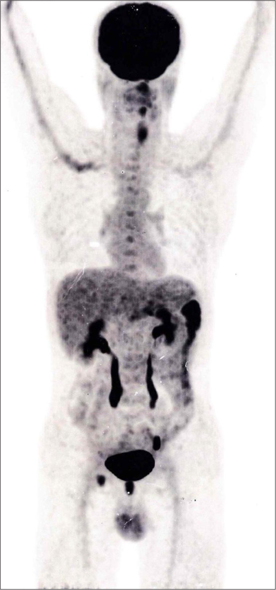 Gastric cancer or hodgkin lymphoma? Unraveling the diagnostic dilemma of primary gastric classical hodgkin lymphoma