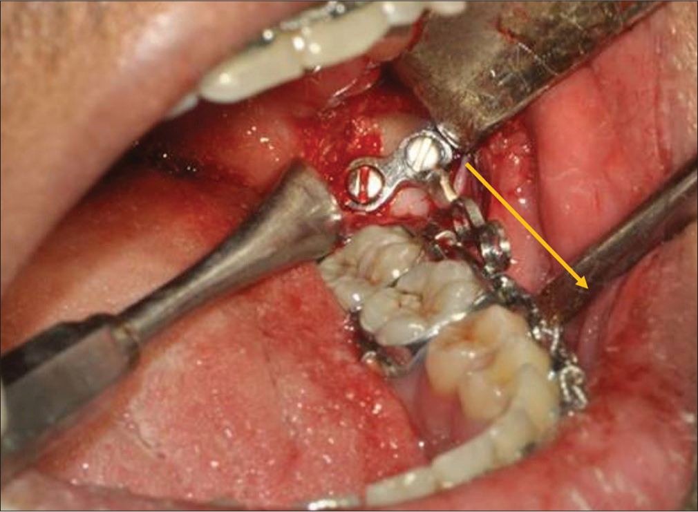 Anatomic considerations during placement of mandibular retromolar miniplates for orthodontic anchorage – A study of the characteristics of retromolar fossa