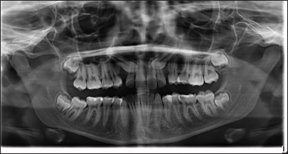 TADs smart easy bending (T.S.E.B.) protocol for impacted canines treatment supported by temporary anchorage devices and aligners