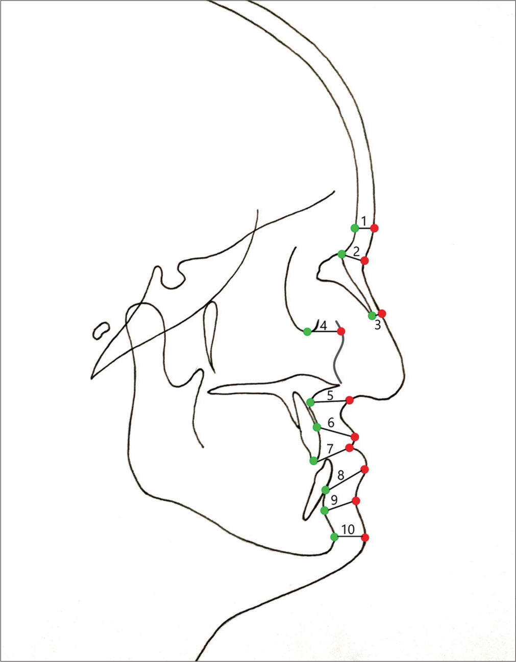 Effect of maxillary distraction osteogenesis and LeFort-1 advancement orthognathic surgery on soft-tissue thickness and anterior soft-tissue to hard-tissue movement ratios among patients with complete unilateral cleft lip and palate