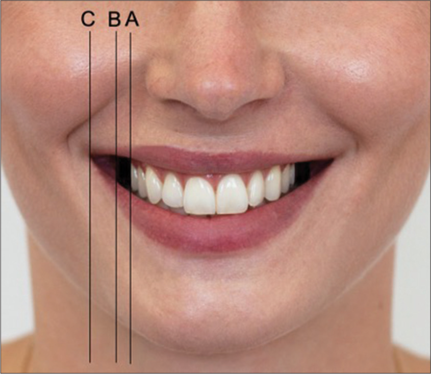 The perception of facial esthetics with regard to different buccal corridors and facial proportions