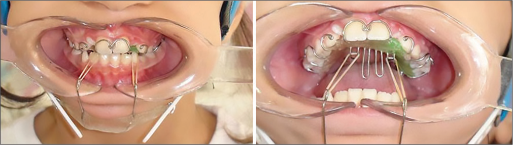 Comparing posterior airway space changes in Class III patients treated with face mask and reverse chin cup