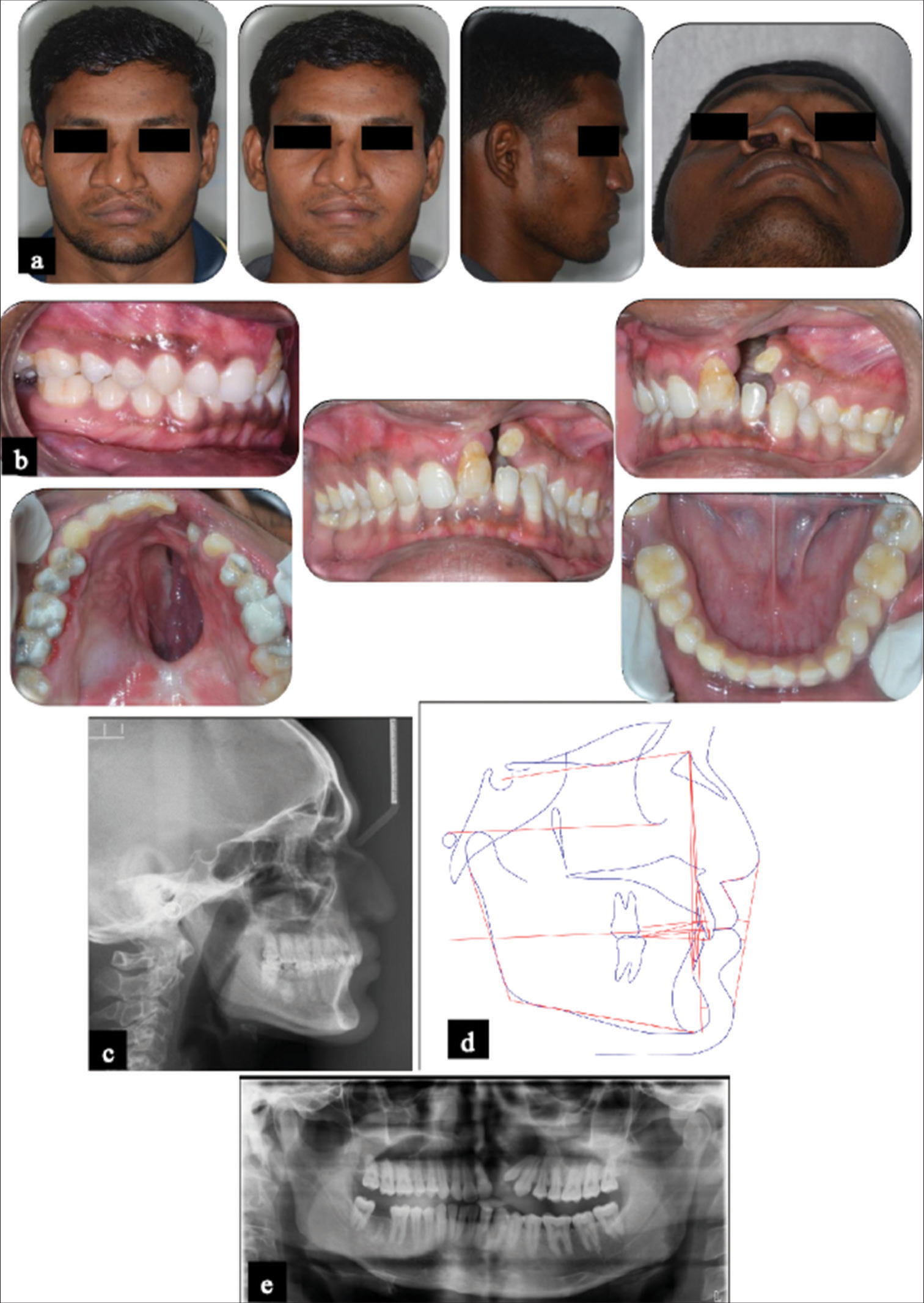 Comprehensive interdisciplinary treatment of patient with unilateral cleft palate and oroantral fistula using archwise Interdental distraction osteogenesis: A case report with 1-year follow-up