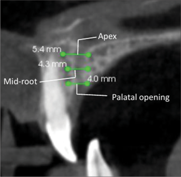 Comparative evaluation of the position of incisive canal and its proximity to the maxillary central incisor roots with different incisor inclinations – A CBCT study