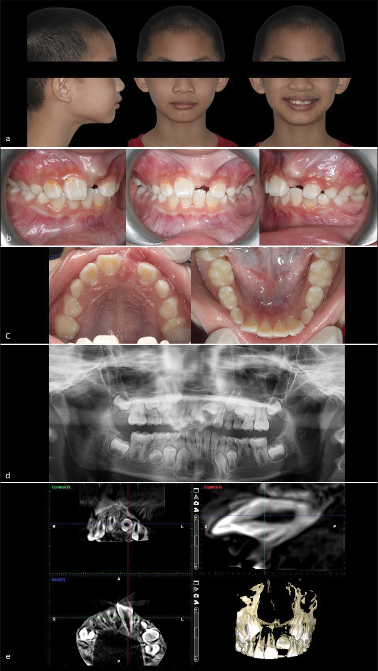 Early intervention of unerupted maxillary central incisor: A case series