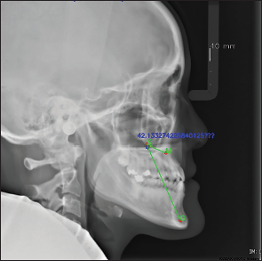 An artificial intelligence-based screening tool for orthognathic surgery using MKG angle in lateral cephalograms