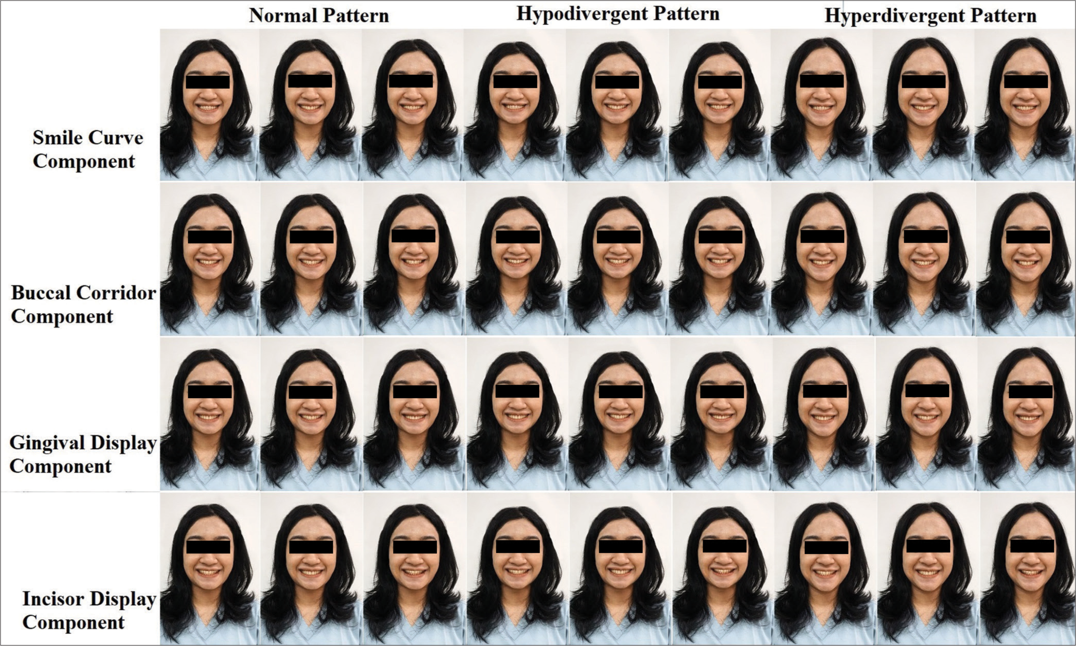 Indonesian orthodontists and laypeople’s perception of the four components of smile analysis in individuals with various vertical skeletal patterns